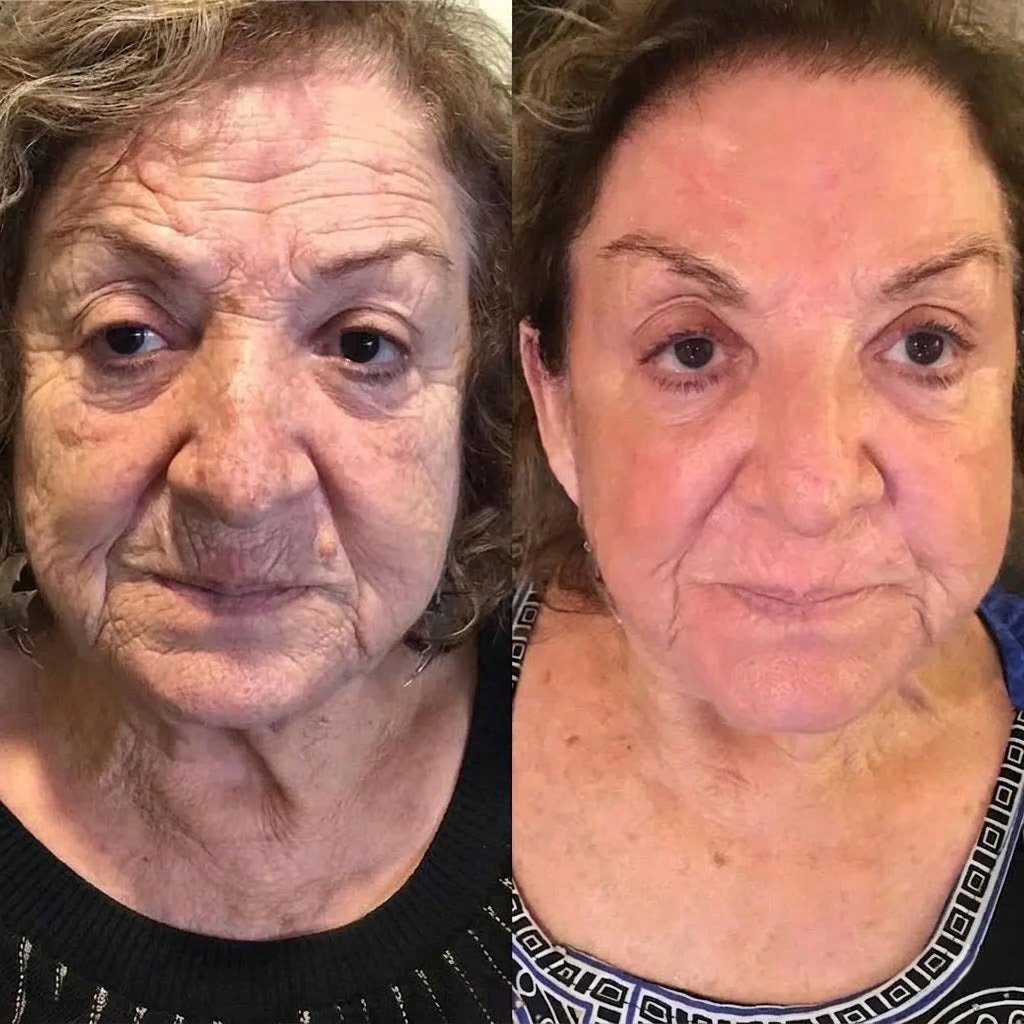 Rolimey® Botox & Vita A Retinol Shot Wrinkle-Lift Tightening cream (upsell)