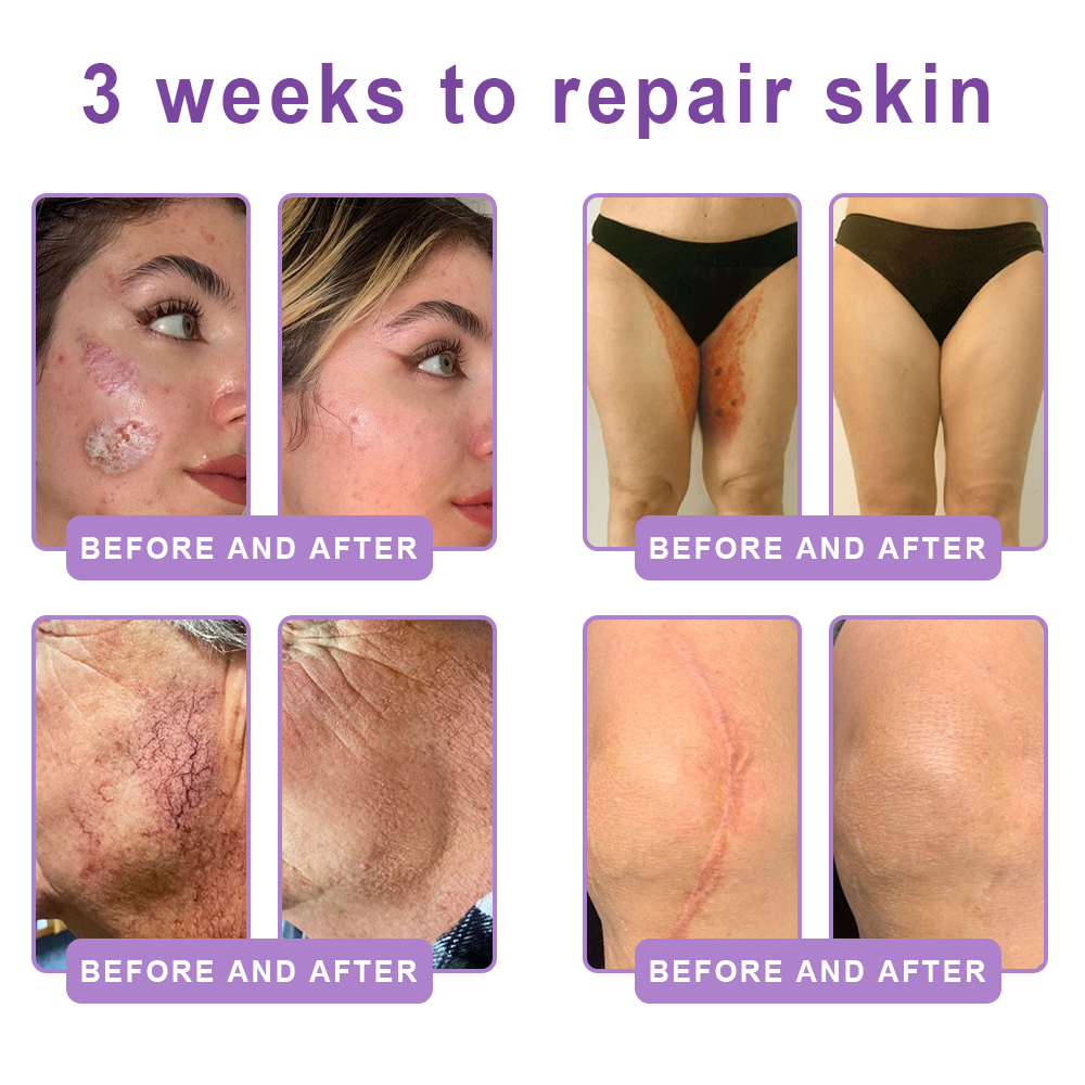 FDA Official: Celsiora® PDRN Multi-Peptide Massaging Body Roller Cream- Anti-aging, Hydrating, Skin Firming & Lifting, Skin Repair, Even Tone, Acne and Dark Spot Treatment, Wart and Mole Removal, and Psoriasis Relief.
