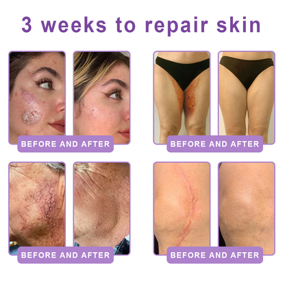 FDA Official: Celsiora® PDRN Multi-Peptide Massaging Body Roller Cream- Anti-aging, Hydrating, Skin Firming & Lifting, Skin Repair, Even Tone, Acne and Dark Spot Treatment, Wart and Mole Removal, and Psoriasis Relief.