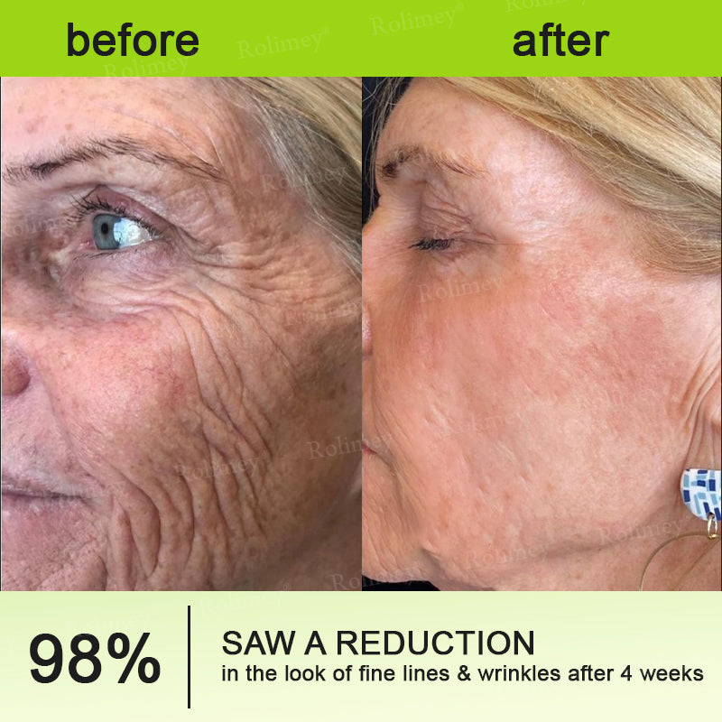 💍🟢Rolimey® Vita-A Retinol Shot Wrinkle-Lift Tightening cream