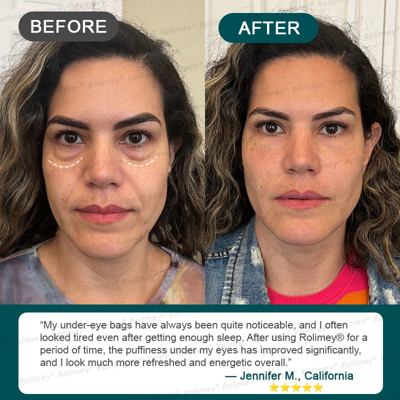 Rolimey® Botox & Stem Cell Wrinkle-Lift Tightening Cream