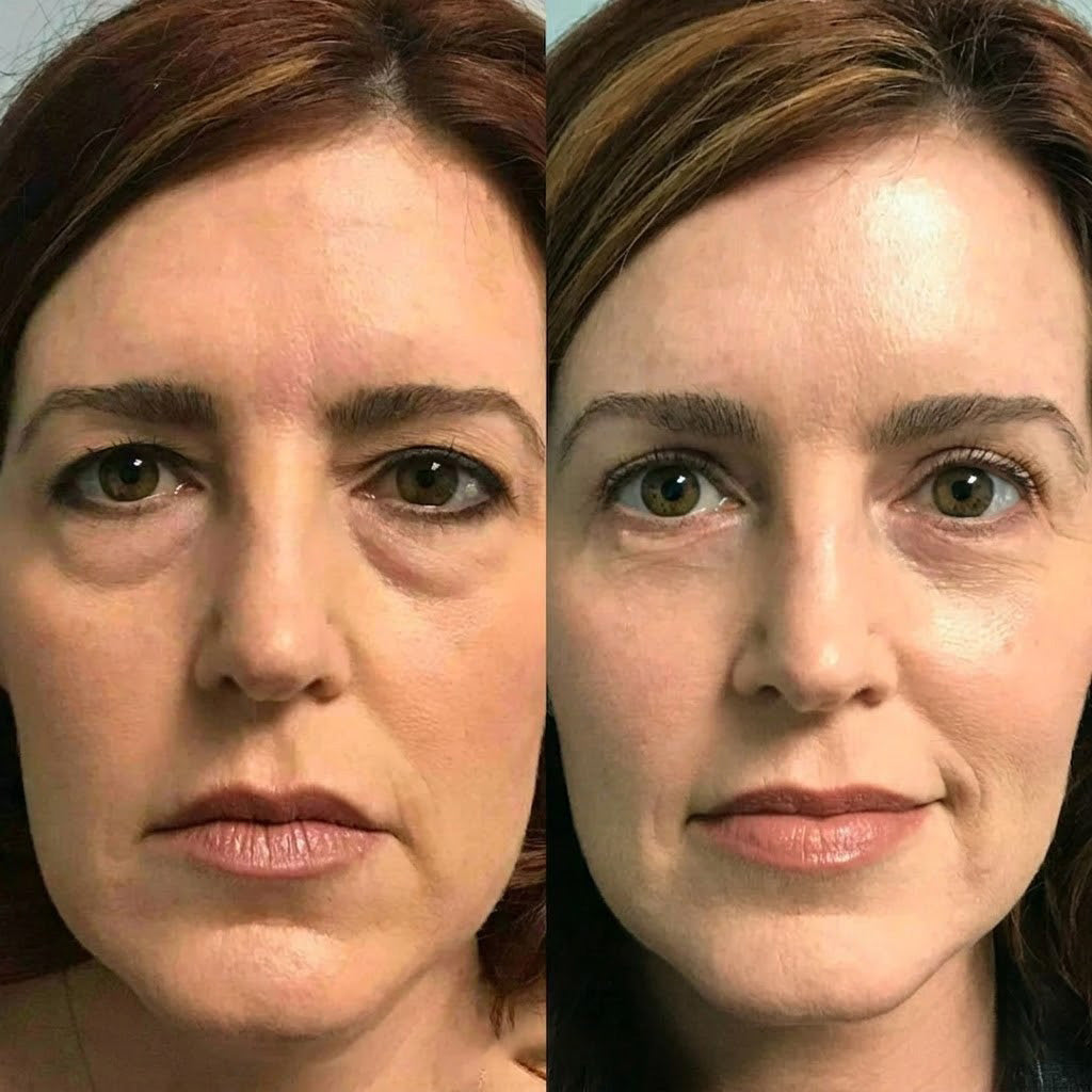 Rolimey® Botox & Vita A Retinol Shot Wrinkle-Lift Tightening cream (upsell)