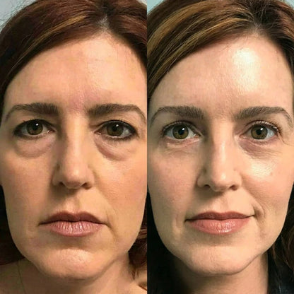 Rolimey® Botox & Vita A Retinol Shot Wrinkle-Lift Tightening cream (upsell)